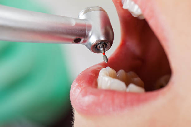 Best Emergency Wisdom Tooth Extraction in Berryville, AR